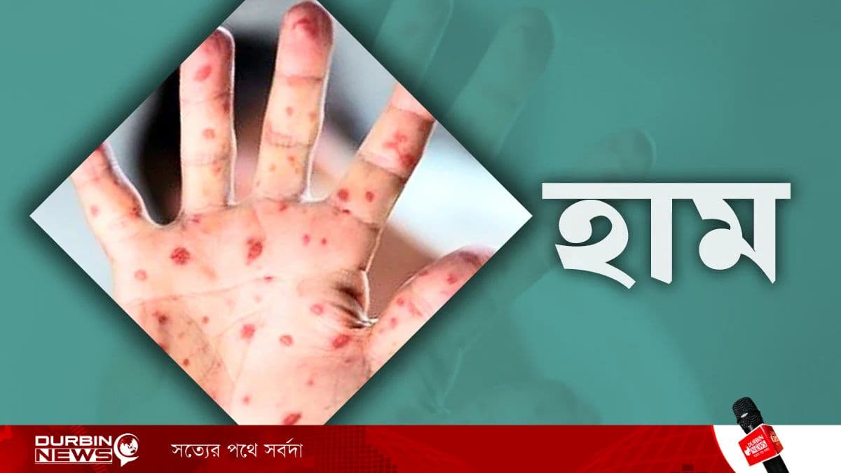 থামছেই না হামের দাপট, ২৪ ঘণ্টায় আরও ৪ প্রাণহানি